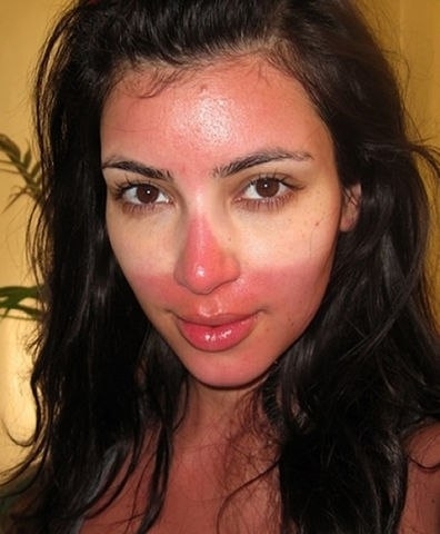 Домашние маски для обгоревшей на солнце кожи  