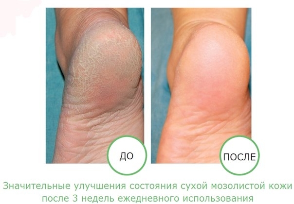 ПРОСТОЙ И ОЧЕНЬ ЭФФЕКТИВНЫЙ ДОМАШНИЙ КРЕМ ДЛЯ НЕЖНЫХ ПЯТОЧЕК! ПРОСТОЙ И ОЧЕНЬ ЭФФЕКТИВНЫЙ ДОМАШНИЙ КРЕМ ДЛЯ НЕЖНЫХ ПЯТОЧЕК!